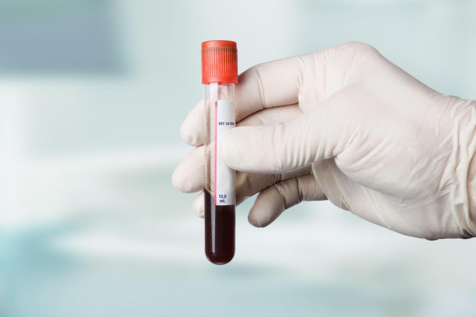 A blood test could be easier, cheaper and faster than current tests for Alzheimer's disease