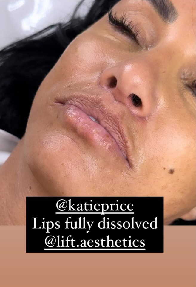 Katie Price previously showed off her natural lips before topping them up once again