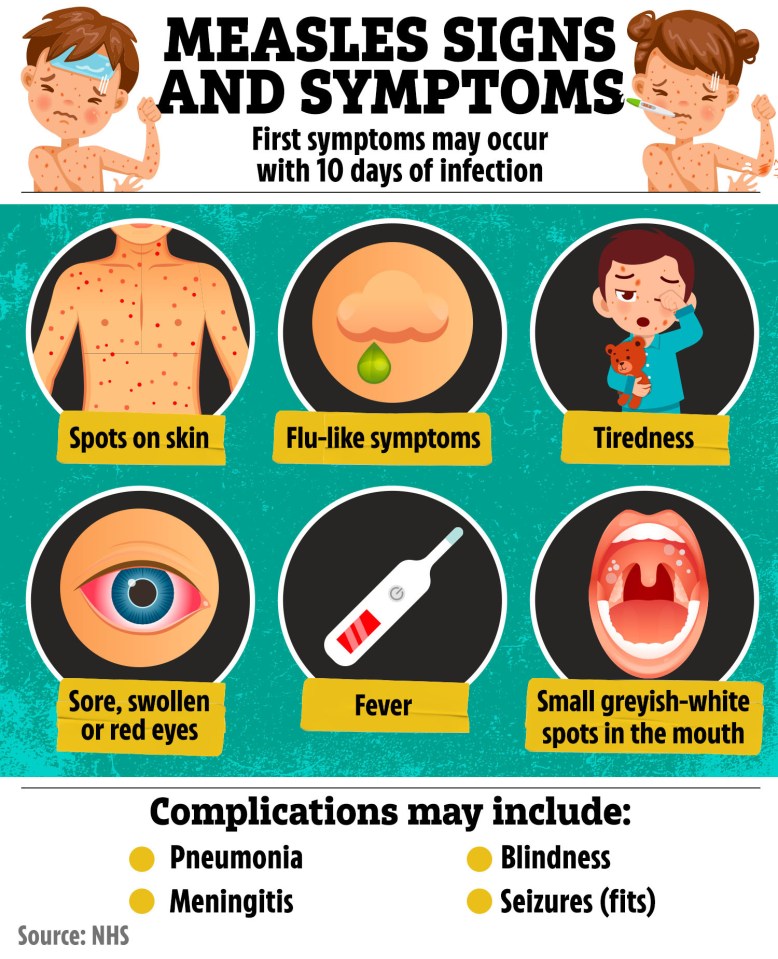 The common symptoms of measles every parent needs to know