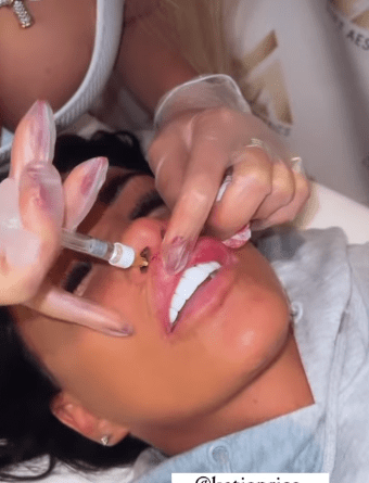 She shared a video of the moment she had her lip fillers topped up