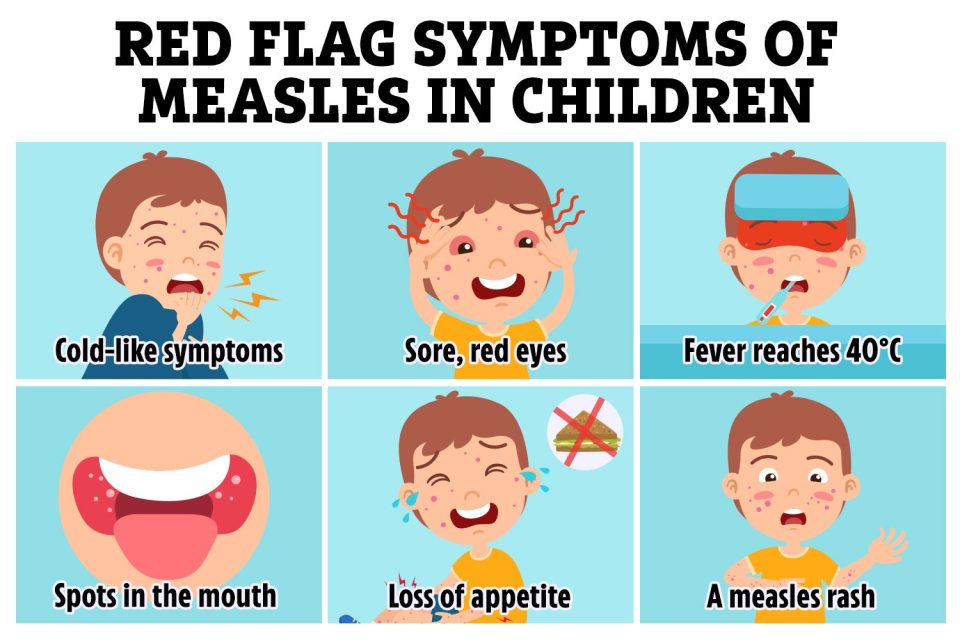 A rash isn't the only red flag symptom of measles