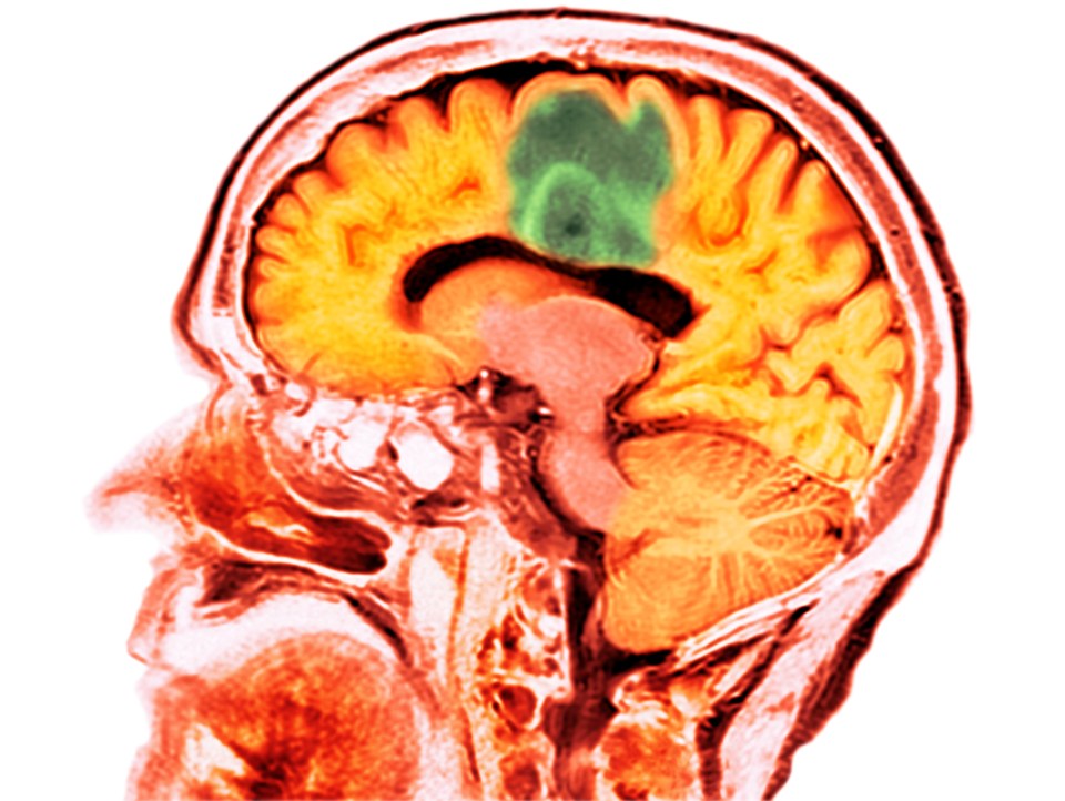 Glioblastoma is the most aggressive form of brain cancer