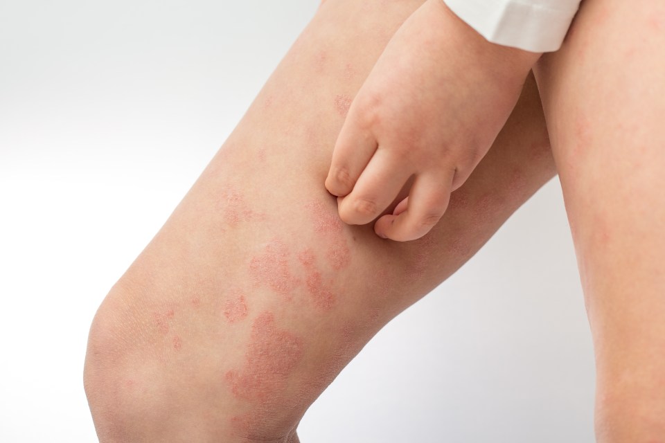 Eczema on the legs