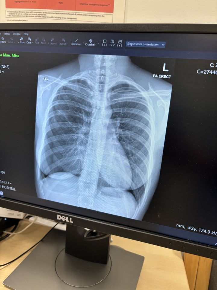 An X-ray of Olivia's collapsed right lung