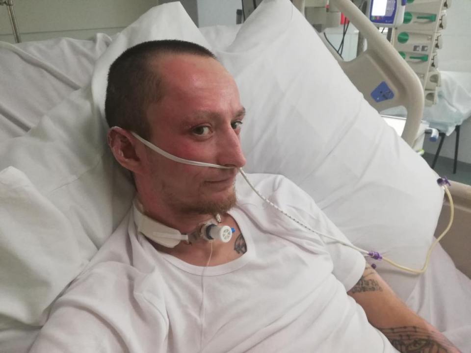 Scott came out of a month long coma and was treated at Broomfield Hospital, a specialist burns unit in Chelmsford