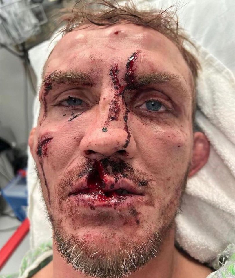 Knight was left battered and bruised following the fight