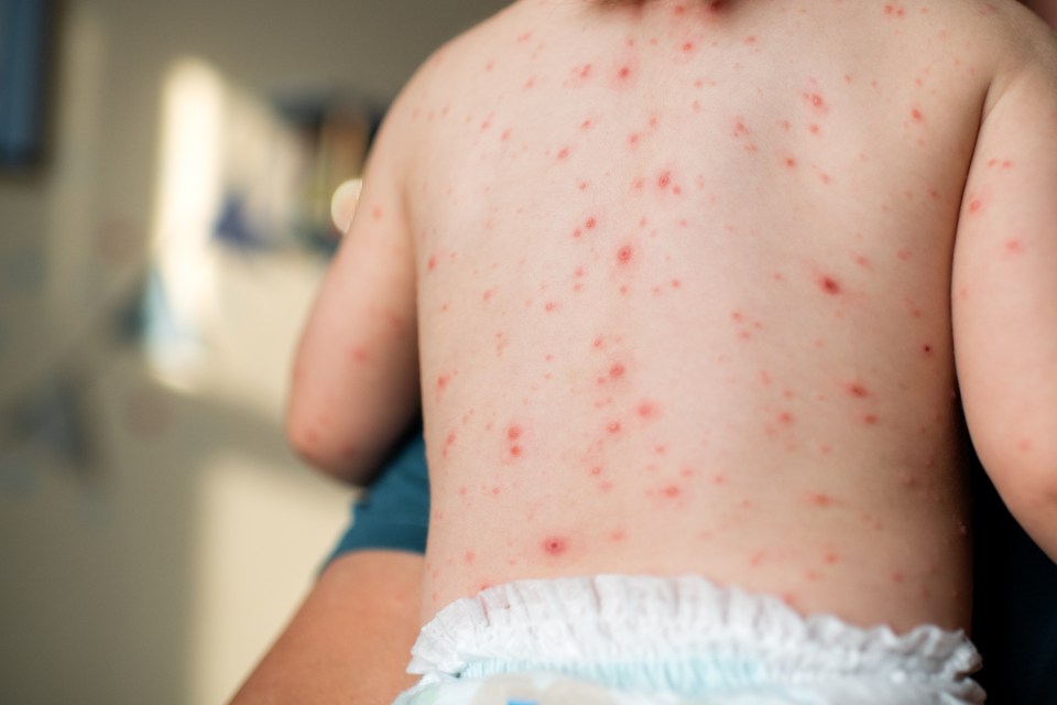 Children are set to be offered a vaccine for chickenpox as part of the NHS routine jabs programme