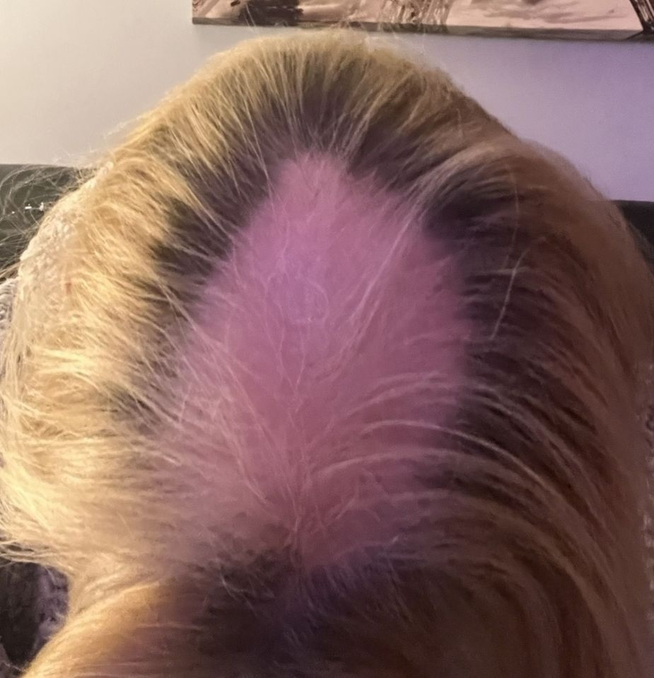 The bald spot grew to the size of a tennis ball