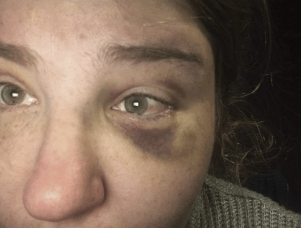 Paige suffered bruising and deep cuts in the brutal attack