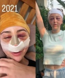 MAFS UK's Ella Morgan has shared some candid snaps taken after her nose job