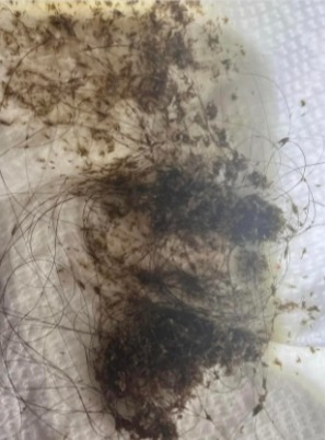 The pictures show the infestation that was found in the child's hair