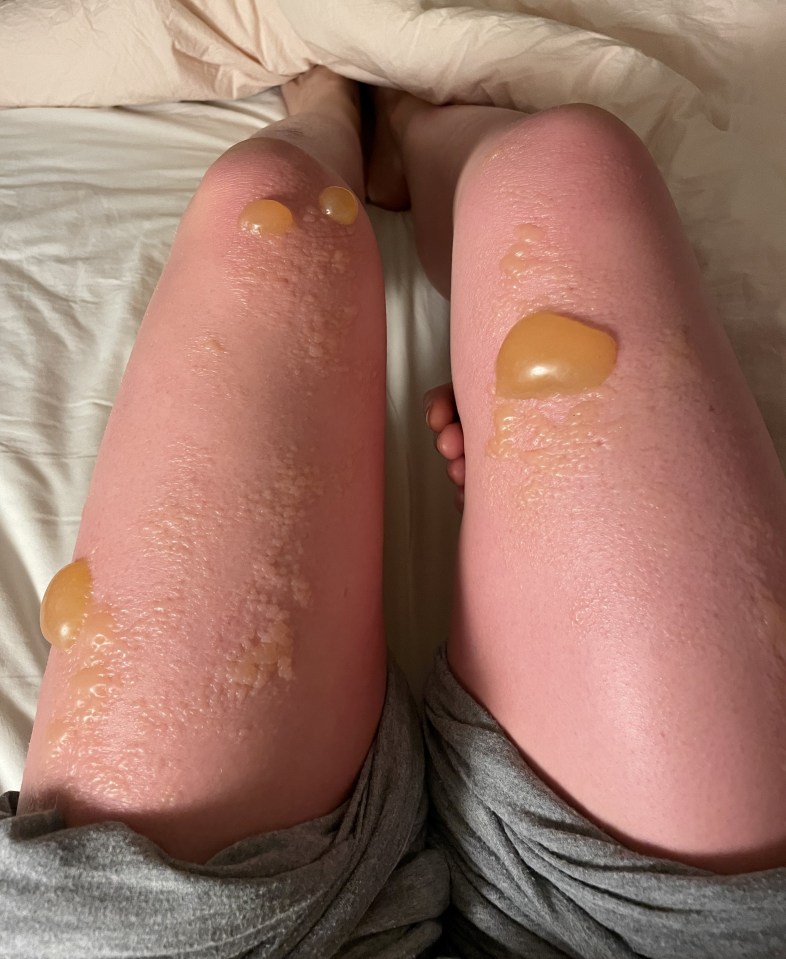 The 22-year-old’s blistered limbs after a day in the heat