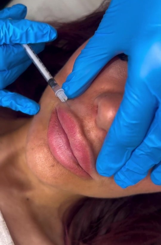 Chloe filmed the process as she got her lip filler dissolved