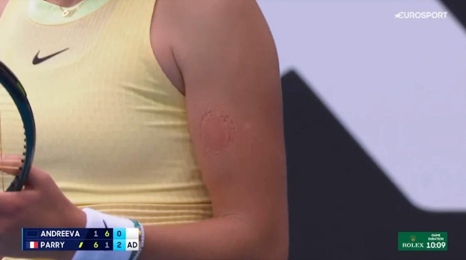 Mirra Andreeva appeared to have bite marks in her arm