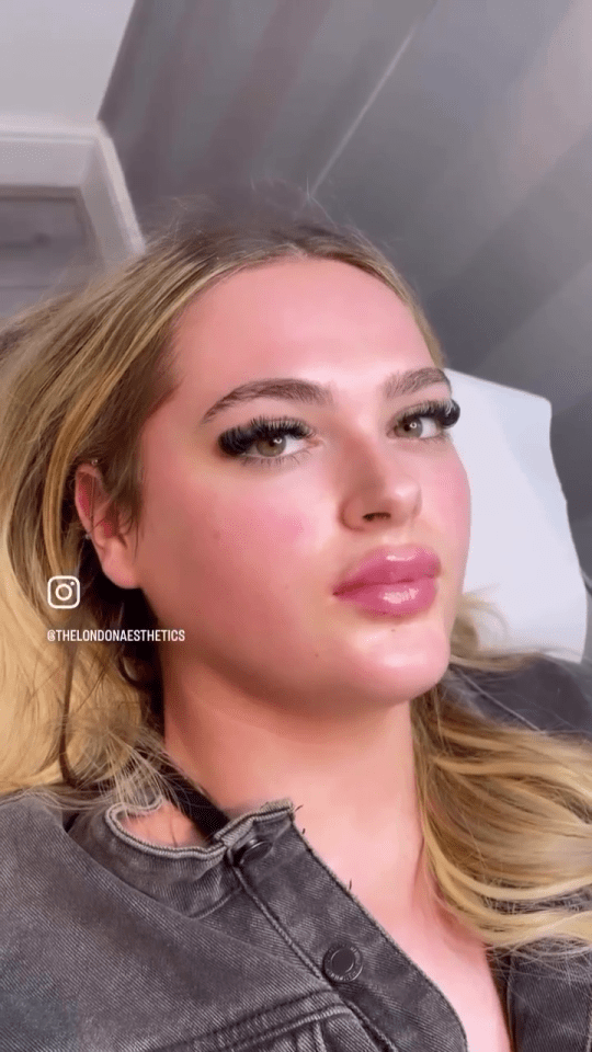 Big Brother's Hallie has had more lip filler