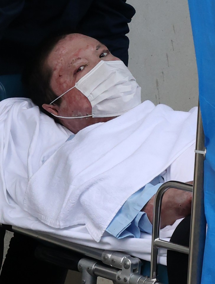 Blistered Shinji Aoba is seen after the arson attack that killed 36 and left him in hospital for 10 months