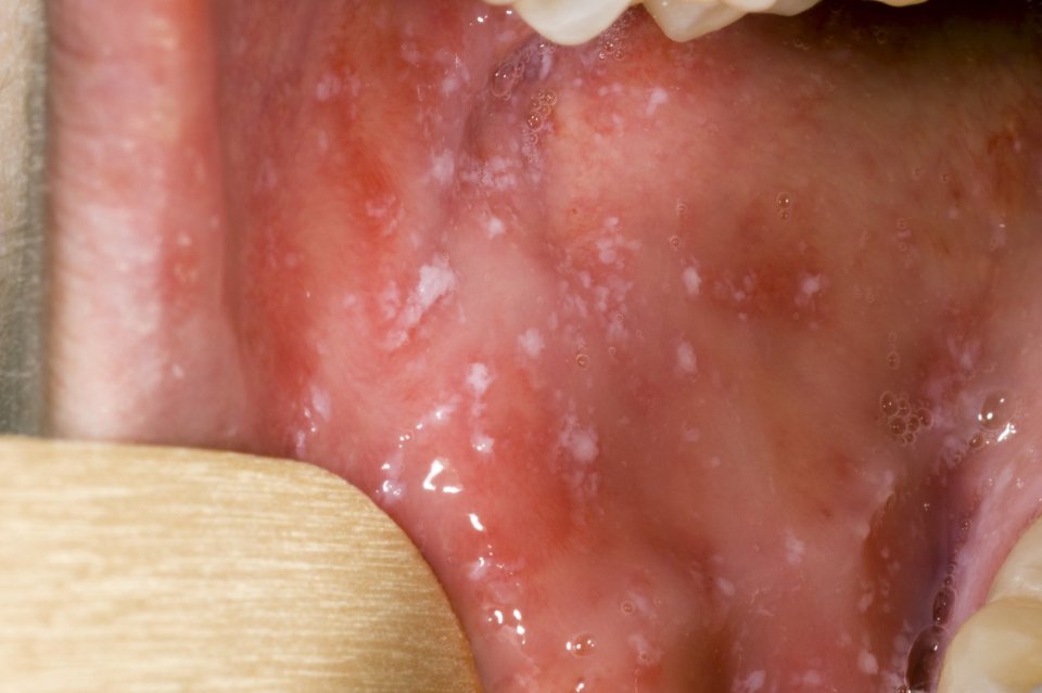 Some people with measles will get white spots inside their mouth