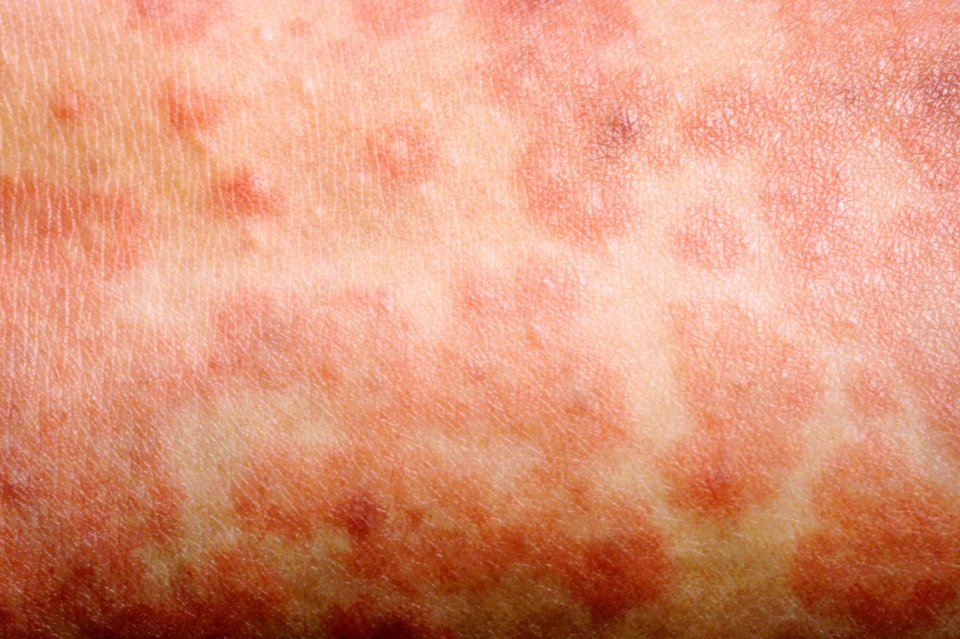 A rash is one of the most common symptoms of measles - but not everyone will get one