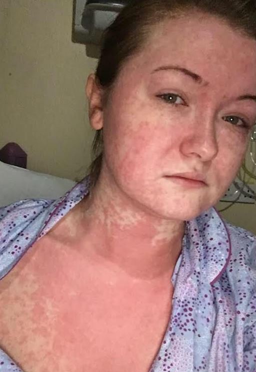 Ellie was rushed to hospital after she fell severely ill with a "horrendous head-to-toe rash