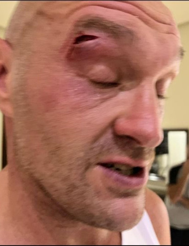 Their historic undisputed fight was postponed due to a huge cut above Fury's right eye