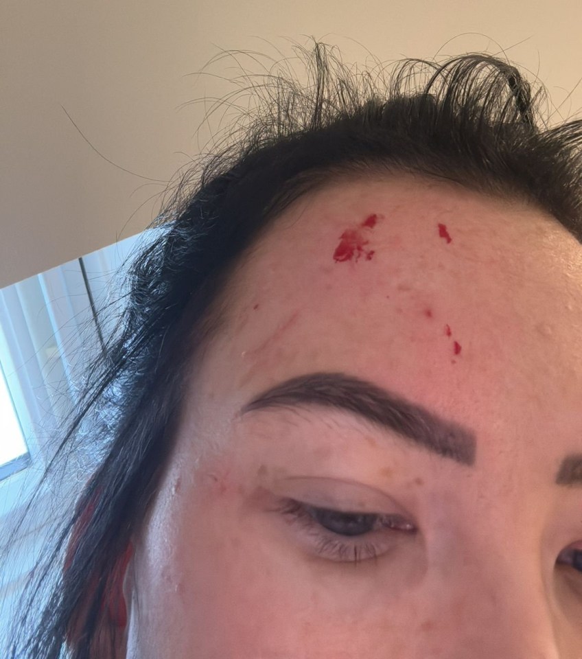 Cuts on Blissica’s head after injuring herself during a fit