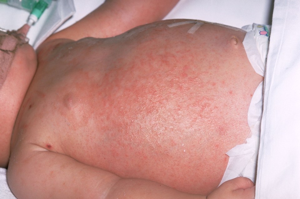 Measles can cause a red rash