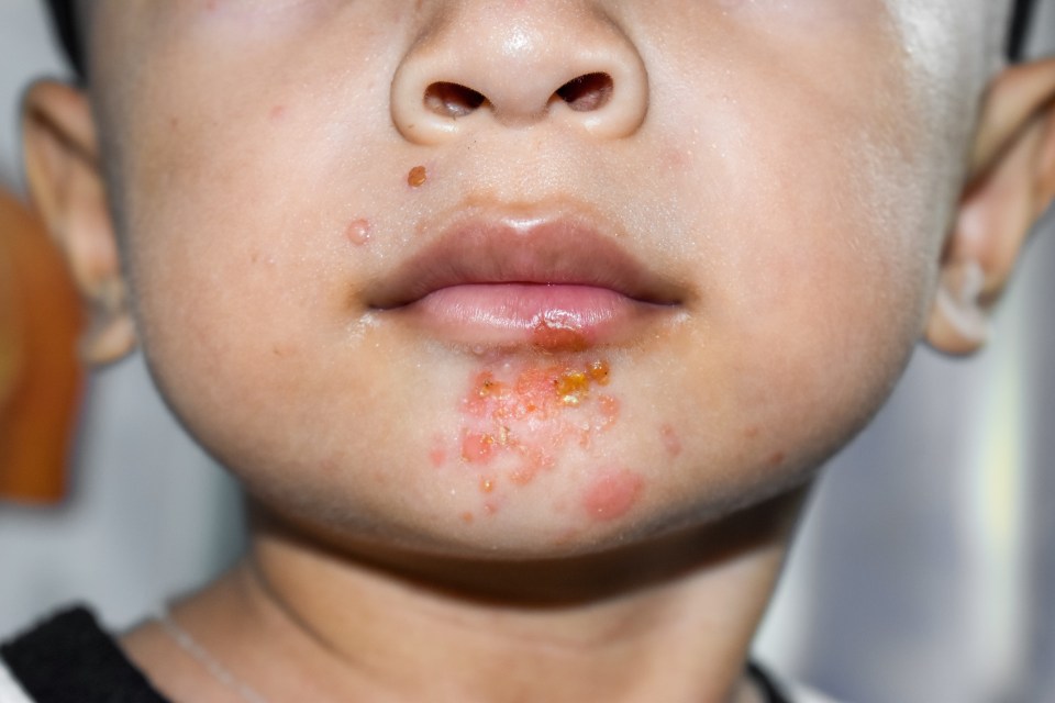 Impetigo starts around the mouth