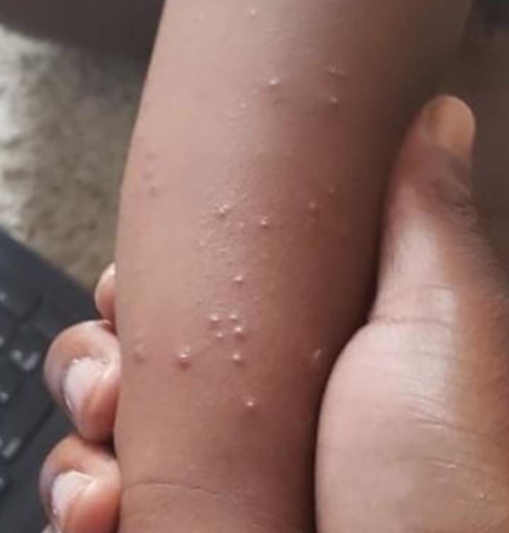 Scabies spreads easily in schools and nurseries