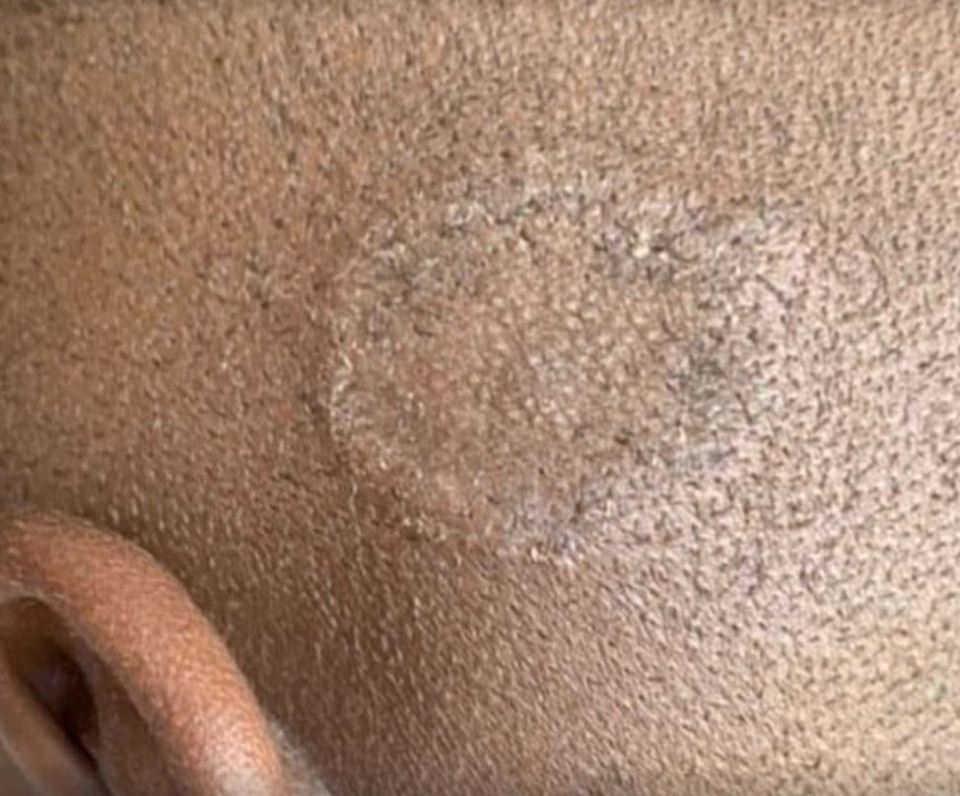 Ringworm can appear on the head too, as shown in this image on darker skin