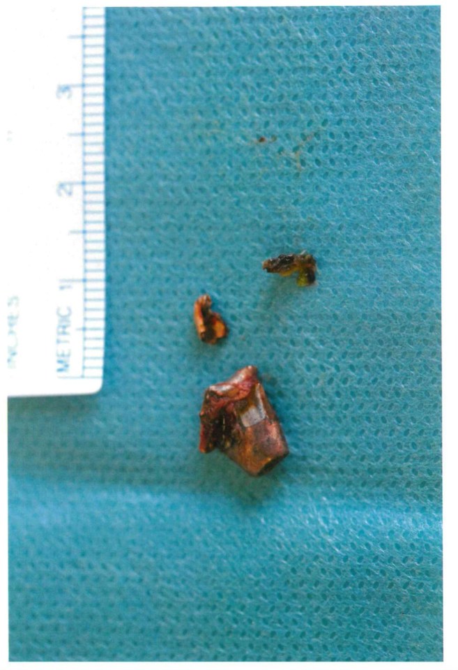 The bullet removed from Iryna’s skull