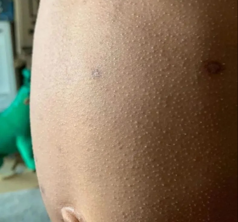 Suspected scarlet fever rash on a darker skin tone