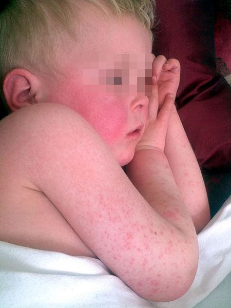 Scarlet fever can cause a rash