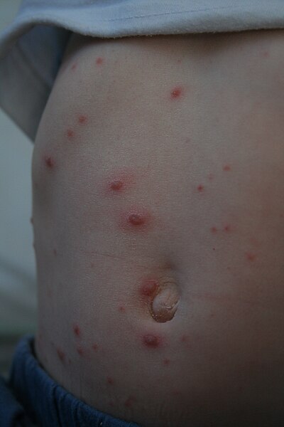 Chickenpox tends to cover most of the body