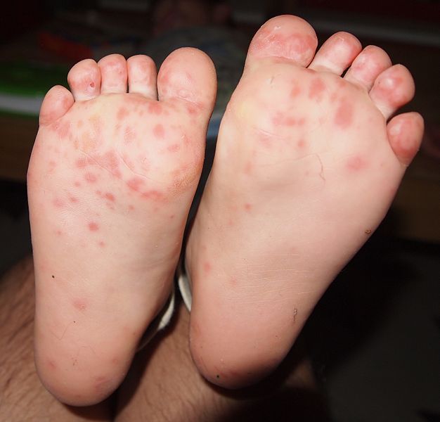 Hand foot and mouth disease usually affects children under the age of seven