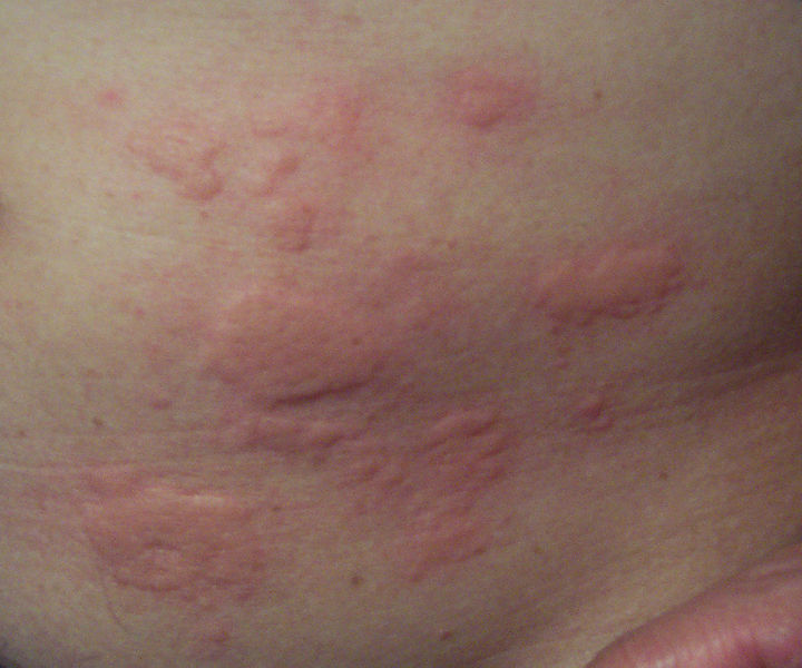 Hives is a raised, itchy rash caused by a reaction to things like food, pollen and insect bites