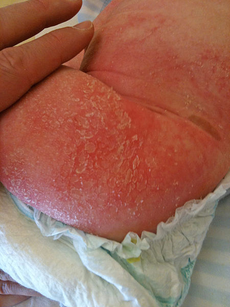 Eczema can look different depending what stage of the flare-up it is in. It can be red, dry, flaky, weeping or bleeding