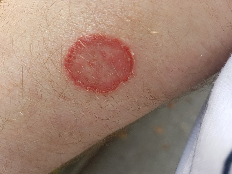 Ringworm rashes are ring-shaped