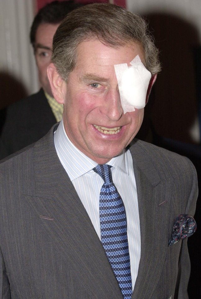 Charles got sawdust in his eye while sawing a branch off a tree at his Highgrove estate