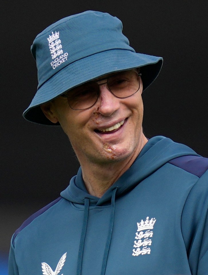 Freddie recently revealed his facial injuries as he trained with the England cricket team