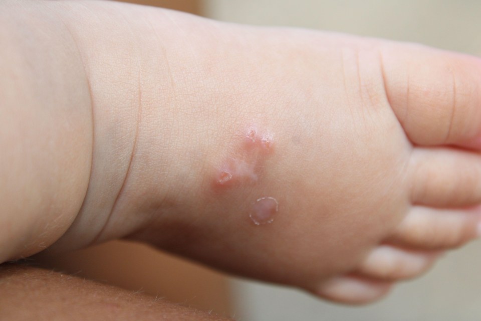 Scabies on on a child's foot