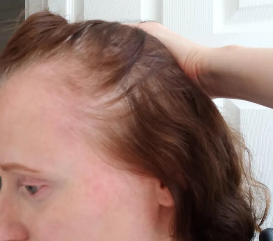 Before using the hair oil, the scalp along the front hairline was visible