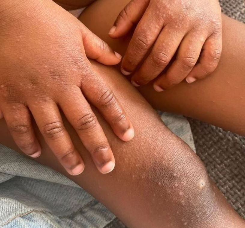 How hand foot and mouth disease may show in darker skin tones