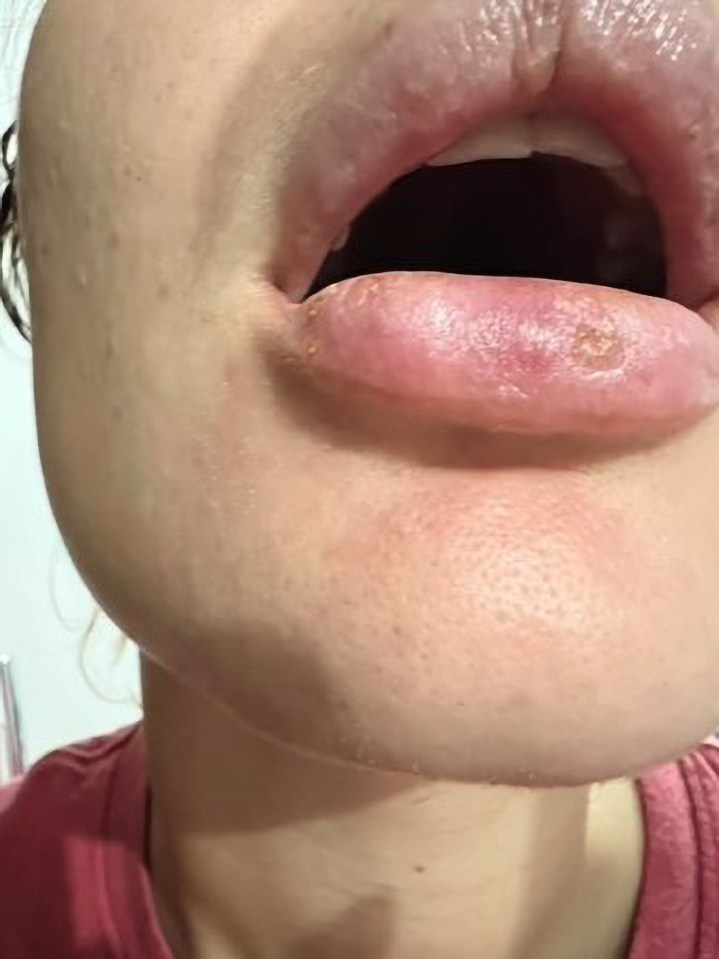 Picture shows Barbara Martiniano’s lips after allergic reaction