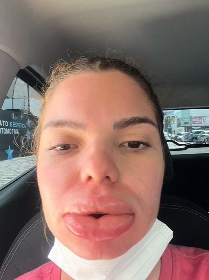 Barbara Martiniano’s lips after an allergic reaction to lip filler