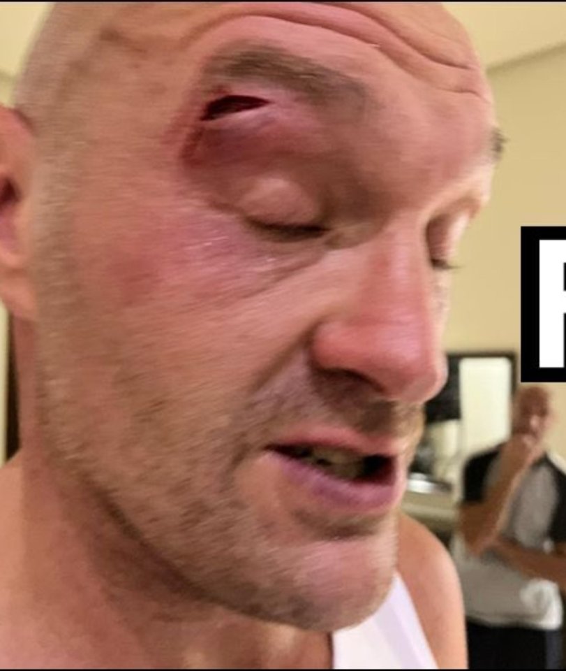 Tyson Fury suffered a huge gash above his eye that led to his fight with Oleksandr Usyk being delayed