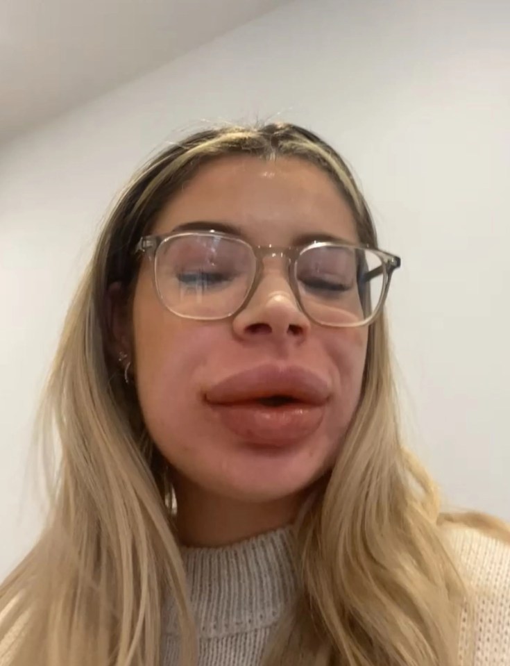 Shauna had an allergic reaction to the solution used to break down her filler