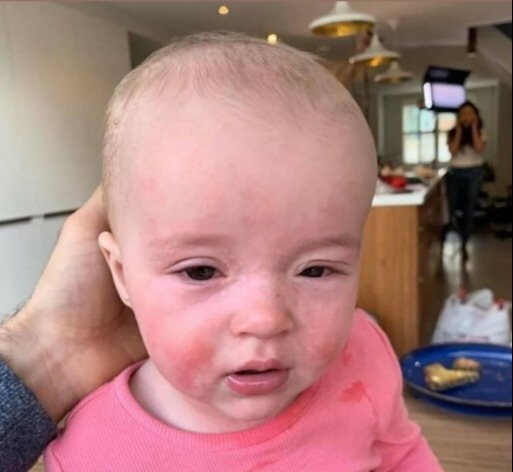 Joe Wicks shared a shocking throwback snap of his daughter's allergic reaction