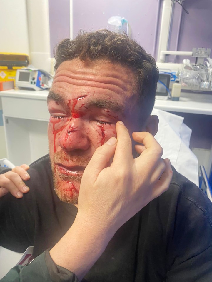 Matthew Syron was blinded in the attack