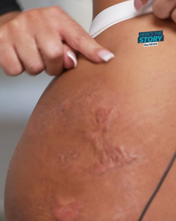 Though she narrowly escaped with her life, the procedure left Monique with permanent scars