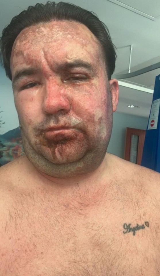 Roofer John Chapman has been left with horror facial injuries after he says he was ‘attacked with acid’